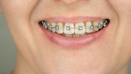 close-up smile. Braces, orthodontic construction on teeth. Dental health concept and bite correction. dental business