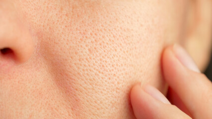 Close-up, macro, skin texture with enlarged pores. Care and treatment of problem skin. Part of a woman face. skin health