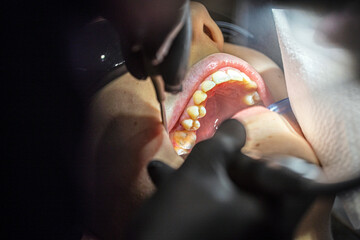 dentist uses a special instrument to restore a patient’s tooth with a mirror. Dental care and care