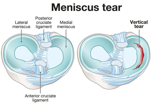 Meniscus tear. Labeled illustration