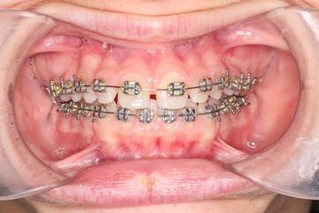 Frontal view of dental arches in biting gap toothed teeth patient. Diastema gap between upper...
