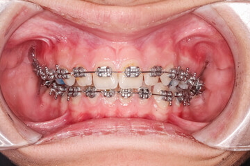 Frontal view of dental arches in biting teeth occlusion with blue resin on the upper premolar, orthodontic braces, arch wire, cheeks and lips retracted with cheek retractor. © MSC