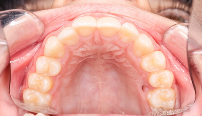 Upper maxillary arch, indirect occlusal view with buccal photography mirror. A hole in the palate,...