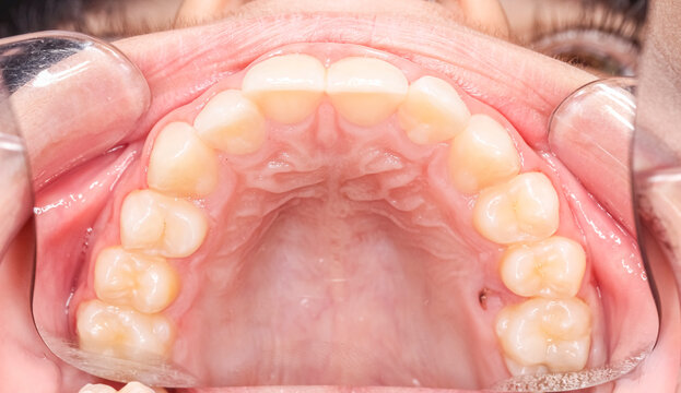 Upper maxillary arch, indirect occlusal view with buccal photography mirror. A hole in the palate, healthy gingival gum, teeth aligned and no decay. Cheeks and lips retracted with cheek retractor.