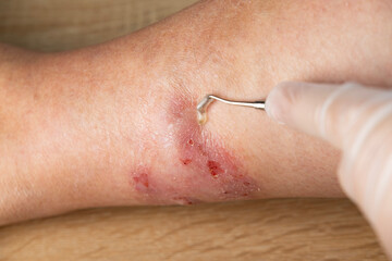 doctor examines itchy skin on leg, inflammation and Medical Allergies, disease on body female...