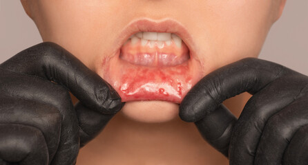 Inflammatory process on the oral mucosa. Stomatitis ulcers on the lips. Treatment of a viral disease.