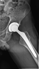 X-ray photo of left hip prosthesis. Lateral view. 12 weeks after total hip replacement