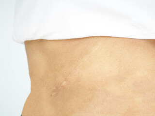 Scars on woman's stomach after gallstone surgery. Medical and health concept.