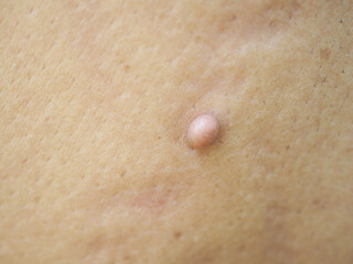 Pink mole, pink birthmark on back of woman. Closeup photo, blurred.