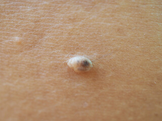 Dark mole on back of woman. Closeup photo, blurred.