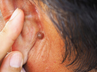 Man pointed to sebaceous cysts on his neck, formed by sebaceous glands. Oils called sebum and laser...
