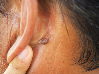 Man pointed to sebaceous cysts on his neck, formed by sebaceous glands. Oils called sebum and laser...