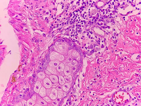Miscellaneous tissue in ovarian teratoma 40x