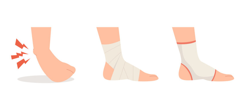 Sprained ankle foot with elastic bandage and ankle support treatments. Concept of twisted ankle, foot pain, bones and ligaments injury, cure, compression bandage wrapping. Flat vector illustration.