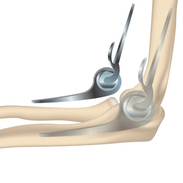 Endoprosthetics of the elbow joint, humeral head. The concept of treating ochteochondrosis, osteoporosis and injuries with metal implants. Medical vector illustration