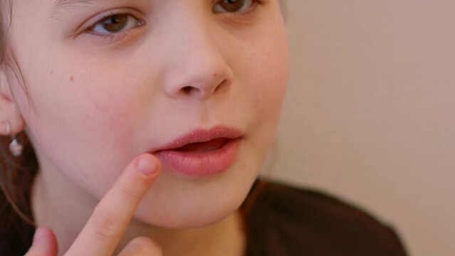 Portrait of a little girl with herpes inflammation on her lips, a viral disease. The chapped lips peel off, the child points with his finger at the sore with itching.