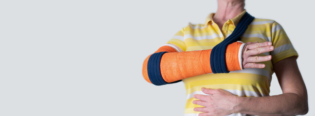 woman with a broken right arm in Fiberglass casts to hold broken bones in place until they heal,...