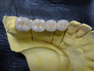 歯科技工のメタルボンド模型・きれいに並んだ白い歯
