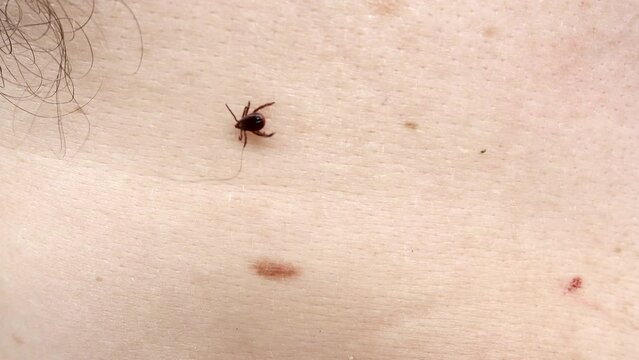 Small Insect Parasite Mite Crawls On a Man's Palm Hand. Tick on the Skin Close Up. Ticks Carry Encephalitis Disease. Blood-sucking Mite Tick Creepers on the Human Skin