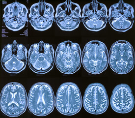 MRI (Magnetic Resonance Image) of brain. Cerebral cortical atrophy.