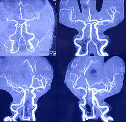 MRI (Magnetic Resonance Imaging) of brain and MRA. Brain showing encephalomalacia with extensive...