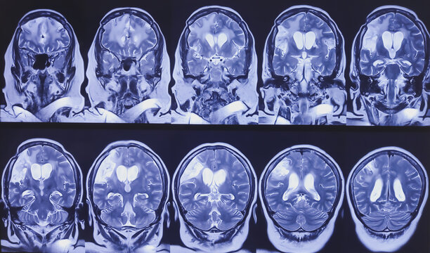 MRI (Magnetic Resonance Imaging) of brain and MRA. Brain showing encephalomalacia with extensive gliosis and lesion in left frontal convexity. Diffuse T2WI FLAIR hyper intensity. Cerebral atrophy.