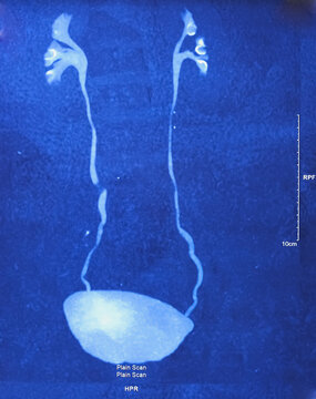 CT (computerized tomography) Urogram, used to evaluate the urinary tract. Left renal small cortical cyst (Bosniak type-1).