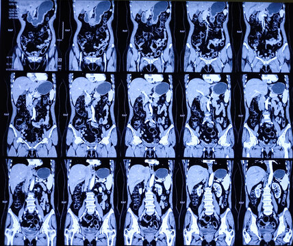 CT (computerized tomography) Urogram, used to evaluate the urinary tract. Left renal small cortical cyst (Bosniak type-1).
