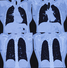 Multi slice HRCT scan of chest showing normal study, normal appearance of the lungs, parenchyma,...