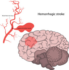 Vector illustration of hemorrhagic stroke.