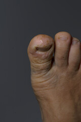disease on human toes felon