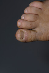 disease on human toes felon