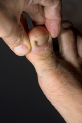 disease on human toes felon