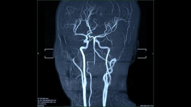 Scan blood vessels brain image or stroke by mri scanner. 