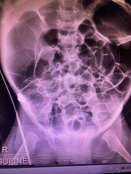 Film. X-ray show generalized bowel dilate with double bowel wall suspected necrotizing enterocolitis for medical study and technology concept 