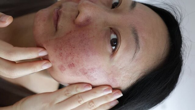 A face of Asian woman who had facial skin treatment by Co2 laser to treat her Acne Scars to get face smooth. Laser can solve this problem