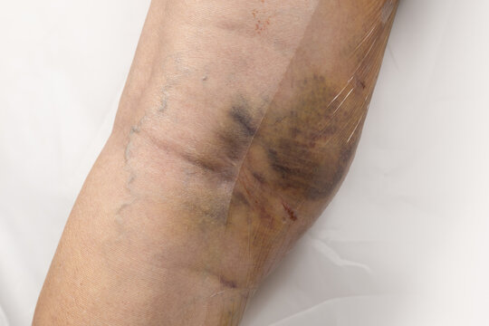 Scars on the lower leg of a woman after varicose vein. Hematomas from traces of a tight compression bandage