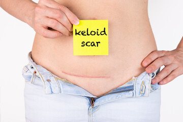 Keloid scar on the girl's body after cesarean section. In her hand is a yellow plaque with the...