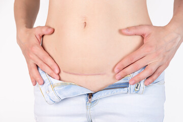 Naklejka premium Woman's belly with a scar after cesarean section, childbirth. Five months after surgery.