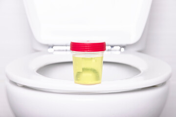 A urine sample in a medical container sits on the rim of a white household toilet. Selective focus.