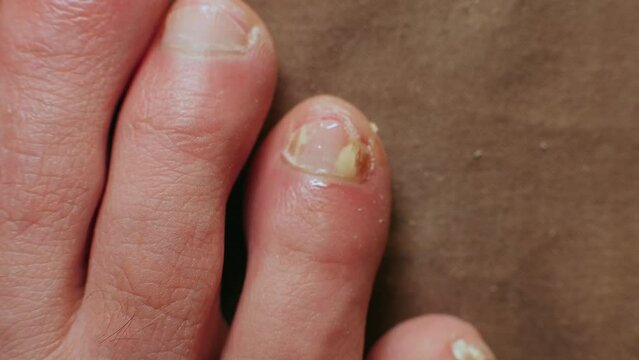 Applying anti-fungal medication to moderately infected toenail
