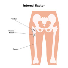 Internal Fixation for Fractures bone