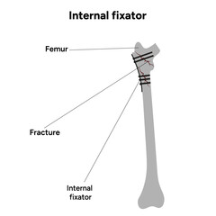 Internal Fixation for Fractures bone