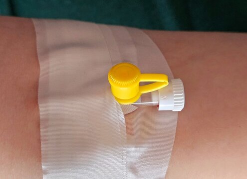 catheter for blood test. catheter in a vein in a patient. Image of a hand with a catheter for blood test from a vein. Patient with intravenous cannula in arm. close up