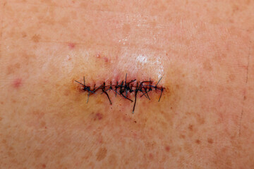 Double sutured scar of abscess surgery on a back