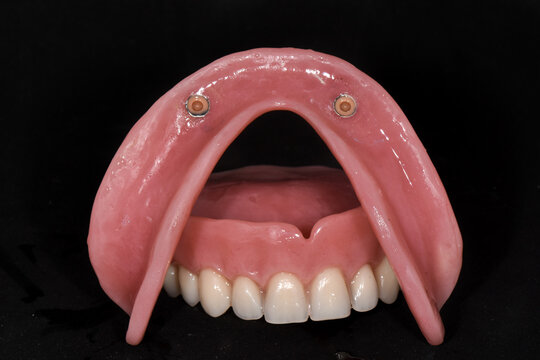A view of removable complete supra-implant prothesis in a black background 