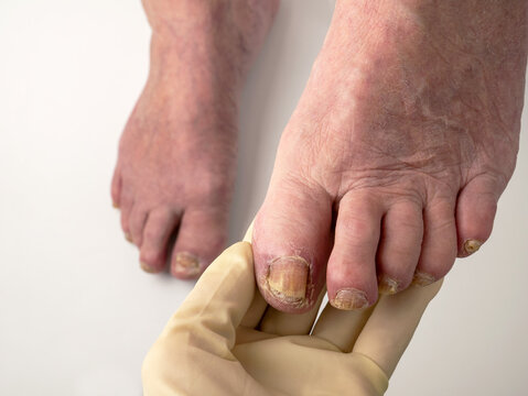 Toenail fungus. A podologist examines toenails affected by a fungal infection. Onycholysis of nails, Paramedicine, Medical pedicure, aging problems