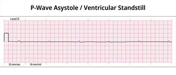 ECG P wave Asystole - Ventricular Standstill - 8 Second ECG Paper - Electrocardiogram Medical Vector Illustration