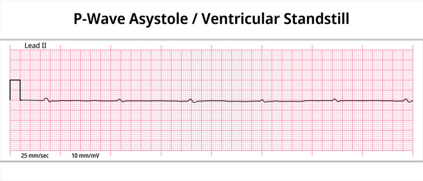 ECG P wave Asystole - Ventricular Standstill - 8 Second ECG Paper - Electrocardiogram Medical Vector Illustration