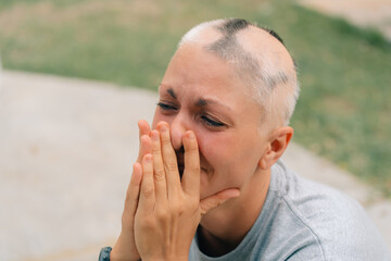 Real alopecia areata in a young girl. A bald head in a person. Diffuse alopecia